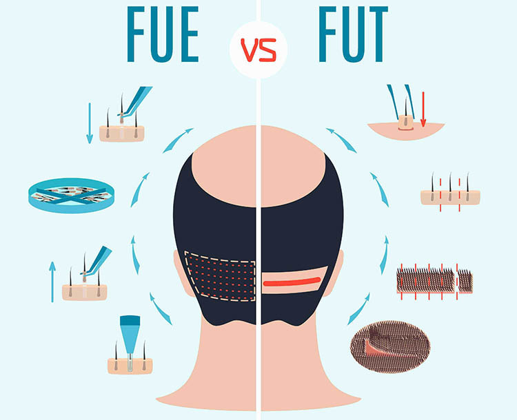 FUE vs FUT